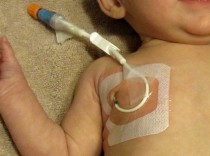 신규간호사일기_Broviac Catheter 브로비악 카테터 관리 : 네이버 블로그