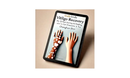 "VITILIGO RECOVERY""My 12 Year Journey to Healing and How You Can Overcome It Too"