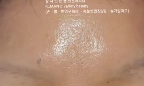 강자안손톱 이미지
