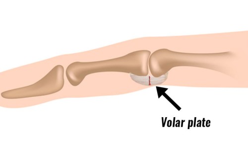 좌측 5번째 손가락 PIP 관절 측부인대 Radial 파열 수술 volar plate injury : 네이버 블로그