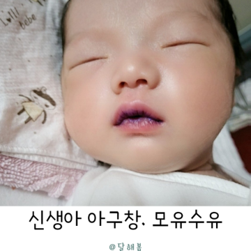 신생아 아구창 원인과 증상 아기 모유 수유