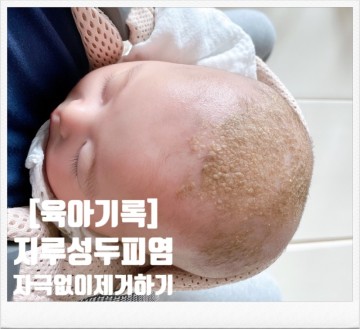 [육아기록] 아기 지루성두피염 떼지않고 깨끗하게 없애기