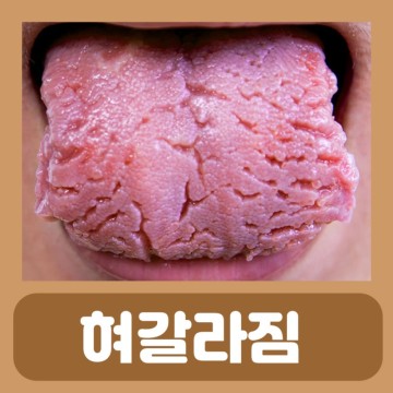 혀 가운데 갈라짐 통증 염증 혓바닥 갈라짐 혀모양 치흔