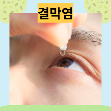 결막염 전염 눈병 증상 원인 눈충혈 안약