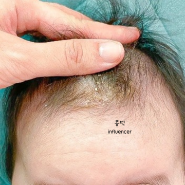신생아 두피지루성피부염 증상 아기머리 각질 관리방법