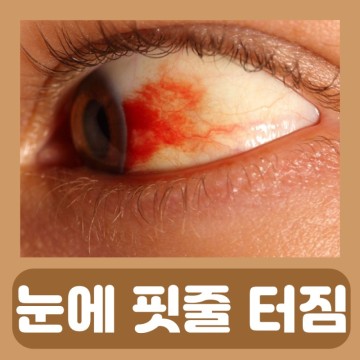 눈에 핏줄터짐 결막하 출혈 한쪽 눈충혈 원인 안약 눈핏줄 터짐 눈 실핏줄 터짐