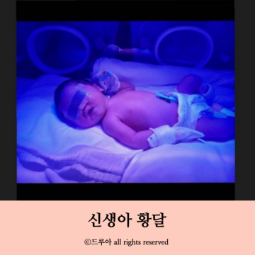 신생아 황달 수치 입원 원인 광선치료 모유 중단