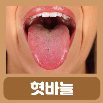 혓바늘 꿀 없애는법 원인 약 알보칠 혀염증 설유두