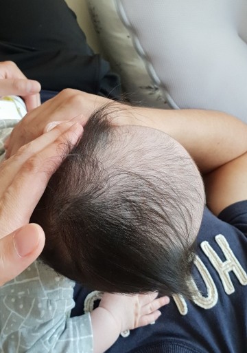 아기사두증 4개월아기 집에서 셀프 교정중