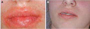 칸디다 입술구순염의 특징