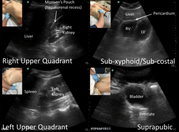 복부 초음파검사(Abdominal Ultrasound)