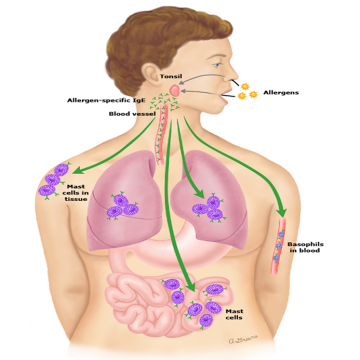 알레르기 검사(1): 아토피는 알레르기 체질 & IgE (면역글로불린 E)