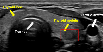 갑상선 초음파 (Thyroid Ultrasound)