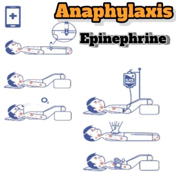 아나필락시스(4): 치료는 가능한 빠르게 에피네프린 사용!