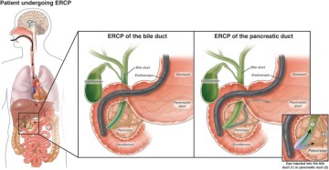 췌장암의 진단과 검사: 내시경적 역행성 담췌관 조영술(Diagnosis of Pancreatic Cancer:ERCP)