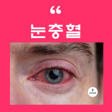 눈 충혈 원인 안약 한쪽 눈충혈 됐을때 핏줄 렌즈 통증 약 눈 충혈에 좋은 음식 완화방법
