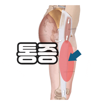 허벅지 근육 통증 - 앞쪽 안쪽 바깥쪽(옆쪽) 뒤쪽 허벅지통증 병원