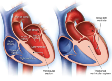 비후성 심근증 HCM (hypertrophic cardiomyopathy)에 대한 이야기