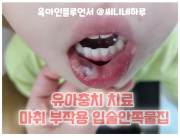 유아충치 비용 마취 부작용 어린이치과 웃음가스 치료 입술안쪽물집