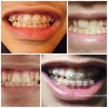 치아교정 가격 통증 3급 부정교합 1년간의 변화. 치아교정기