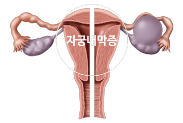 자궁내막증 원인과 증상