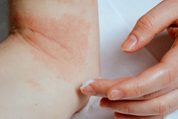 아토피성 피부염 원인과 증상 관리 방법 및 성인아토피 크림 추천