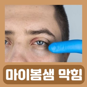 마이봄샘 막힘 염증 안검염 눈꺼풀 부음 눈에 기름 눈물샘 막힘 염증