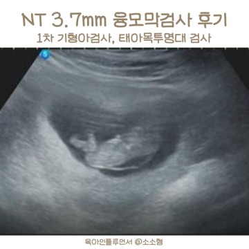 임신 1차 기형아검사 태아 목투명대 NT 3.7mm 융모막검사 결과