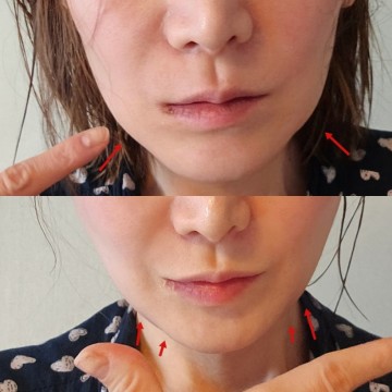 민트 실리프팅 효과 넙대대한 땅콩형 얼굴 브이라인 찾은 비용 붓기 부작용 후기