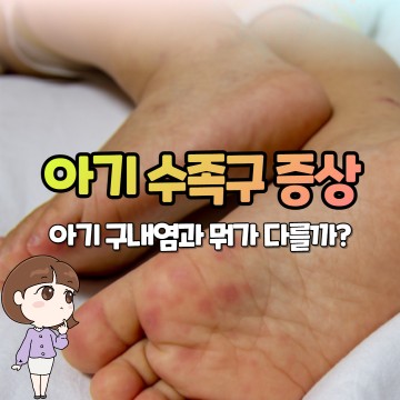 아기 수족구 증상 및 원인 vs 유아 구내염 