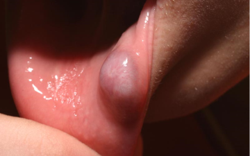 입술 입안 점액낭종 증상 및 원인과 치료